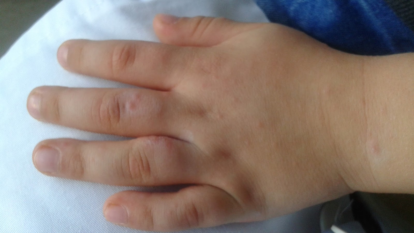 De ce se exfoliaza unghiile la copii